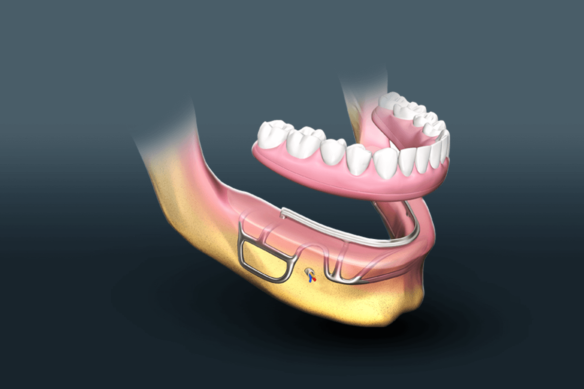 Implants Dentaires Chez Saphiredent Istanbul Turquie